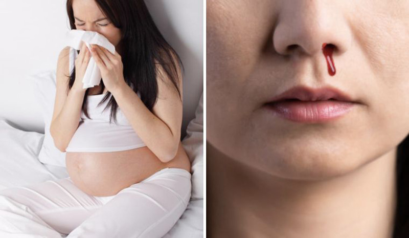 Liệu Mẹ Bầu Chảy Máu Cam Có Đáng Lo Ngại?